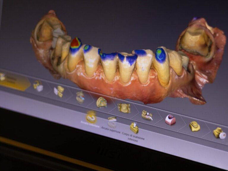 Modello di arcata molare con marcature colorate sui denti, esposto su un vassoio con piccole parti dentali sottostanti.