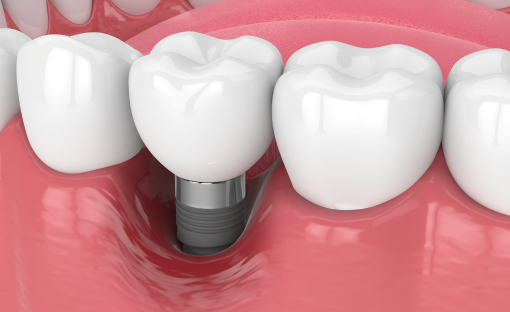 Il rigetto degli impianti dentali (la perimplantite)