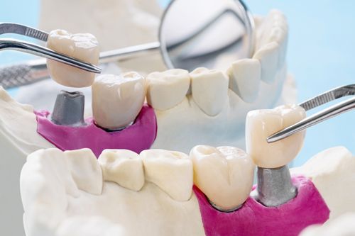 A model of a person's teeth with a dental bridge and a dental mirror.
