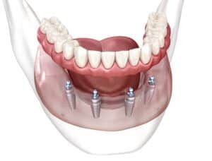 Animation shows how all-on-4 dentures connects an entire row of teeth on just four implants