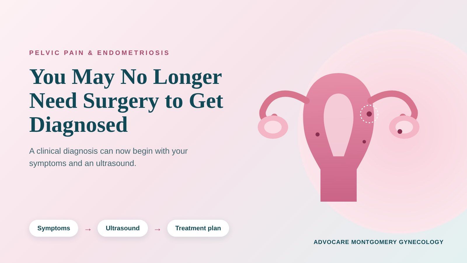 Illustration of a uterus with symptoms, ultrasound and treatment plan labels for an endometriosis di