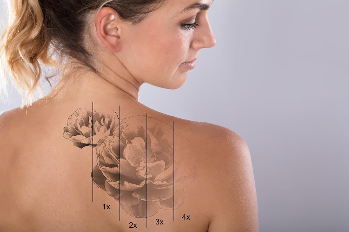 Tattoo removal images before and after near Lexington, Kentucky (KY)