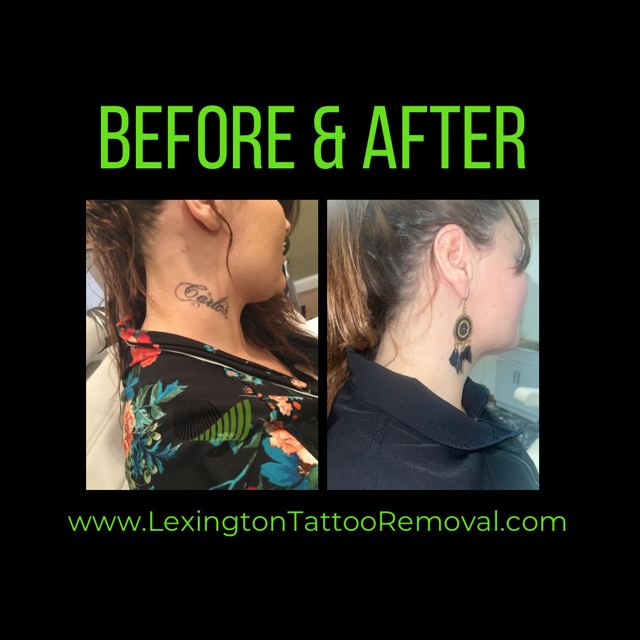 Before and after image of the neck showing remarkable transformation after laser tattoo treatment
