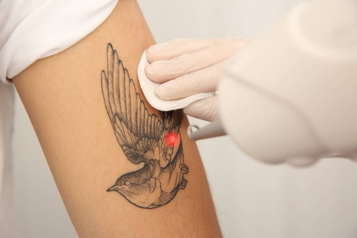 Someone receiving a laser tattoo removal treatment on their arm near Lexington, KY
