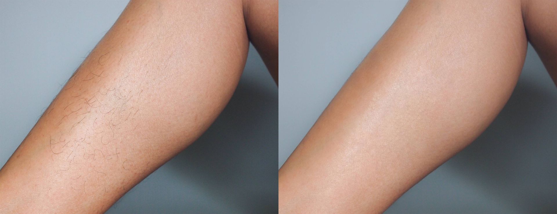 A before and after image of laser hair removal and recovery at Lexington Tattoo Removal near Lexington, KY