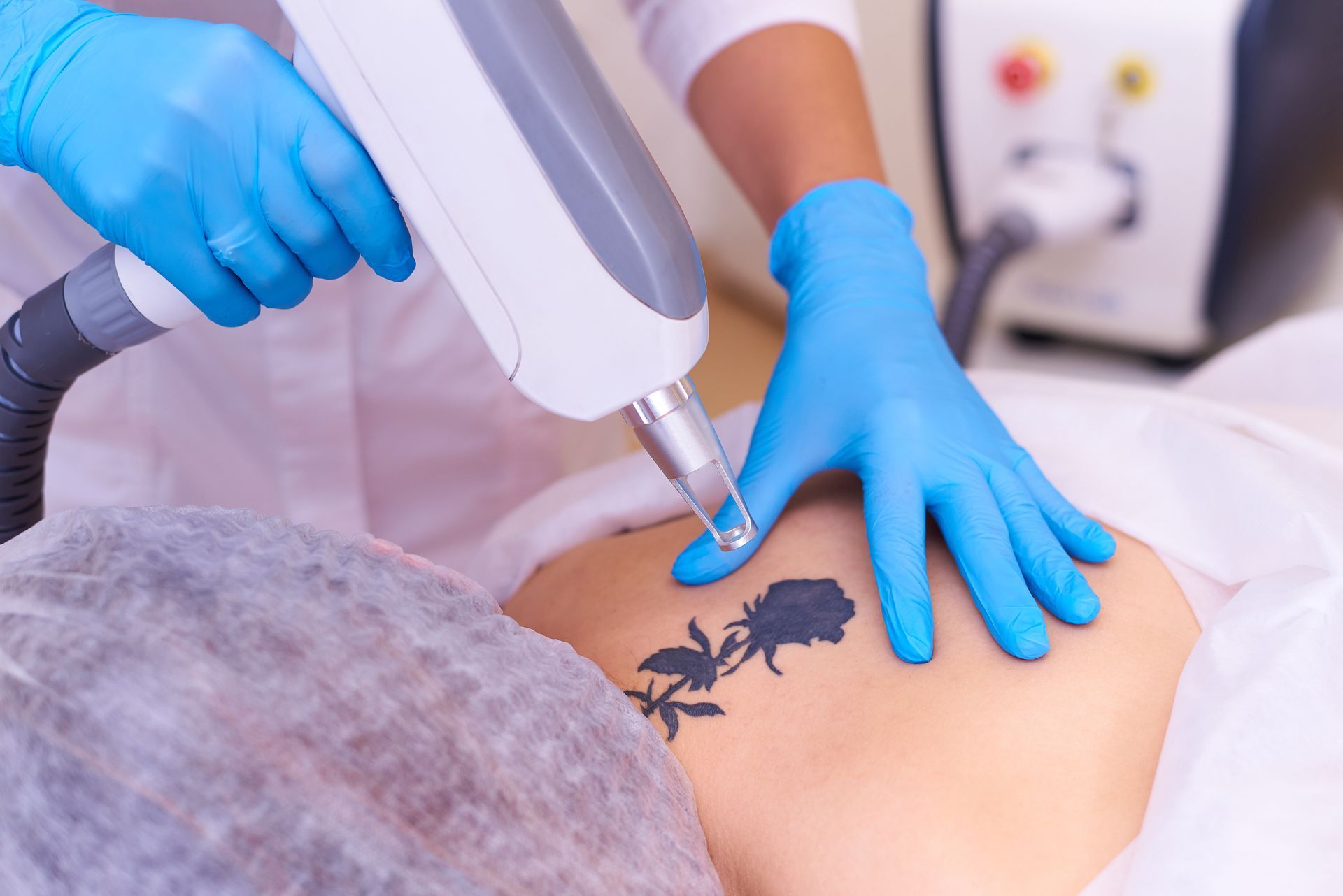 Laser tattoo removal in a cosmetology clinic 