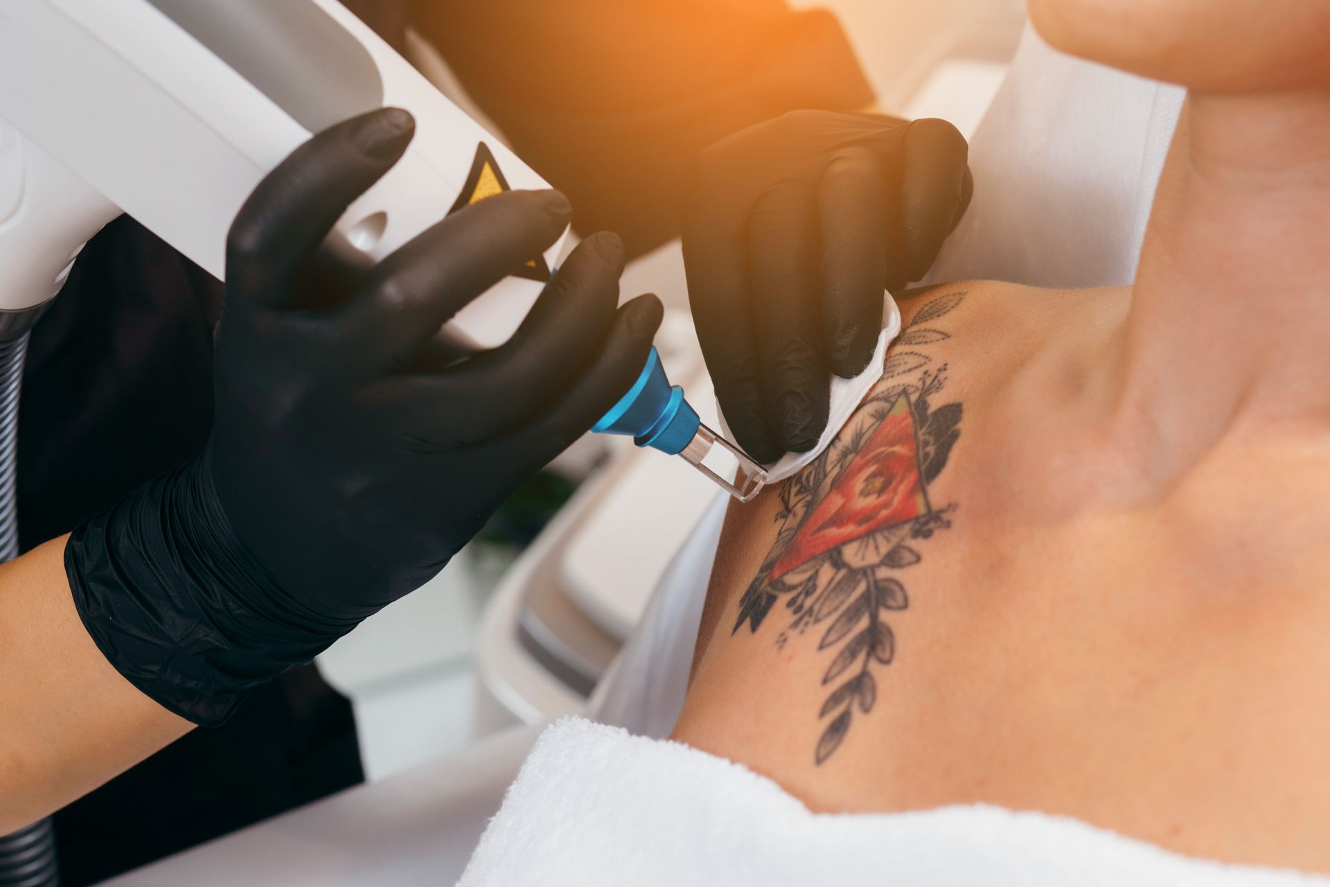Someone getting a shoulder tattoo removed with a laser 