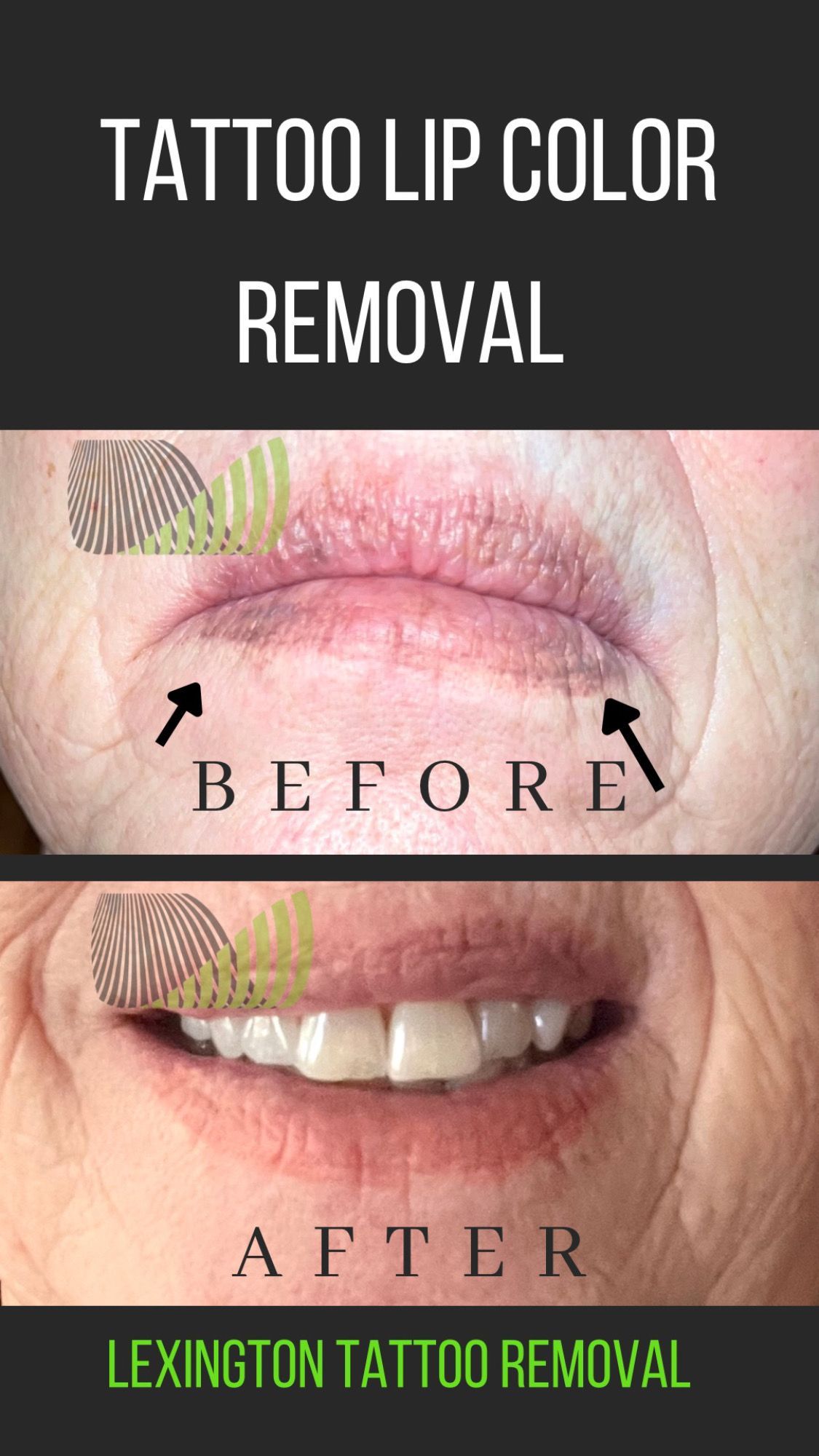tattoo lip color removal before and after pictures