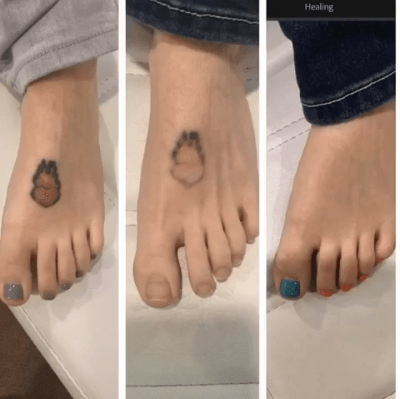 Before & After Tattoo Removal Lexington Tattoo Removal