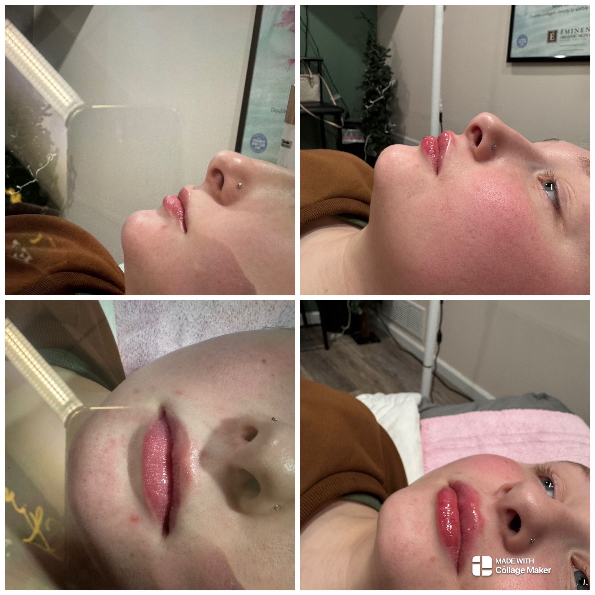 A woman is getting a lip injection in a beauty salon.