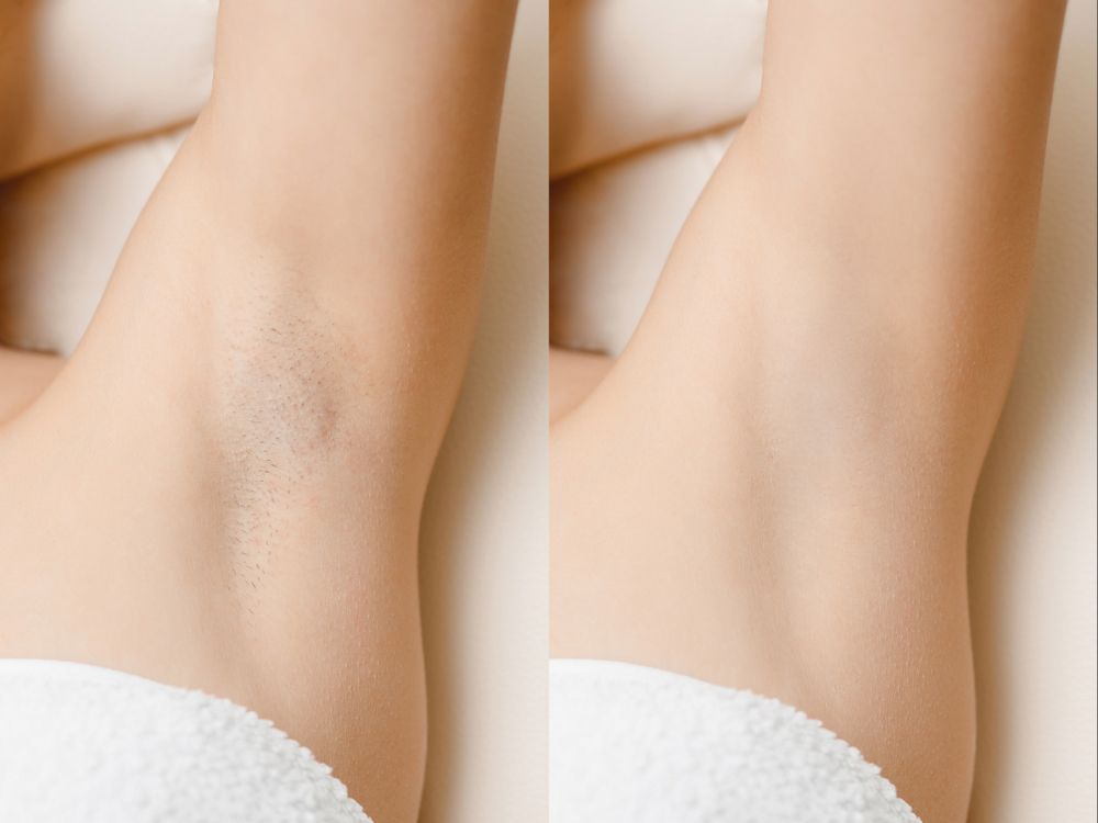 A Before and After Photo of a Woman's Underarm — Aqua Marine Skin and Beauty in Tuncurry, NSW