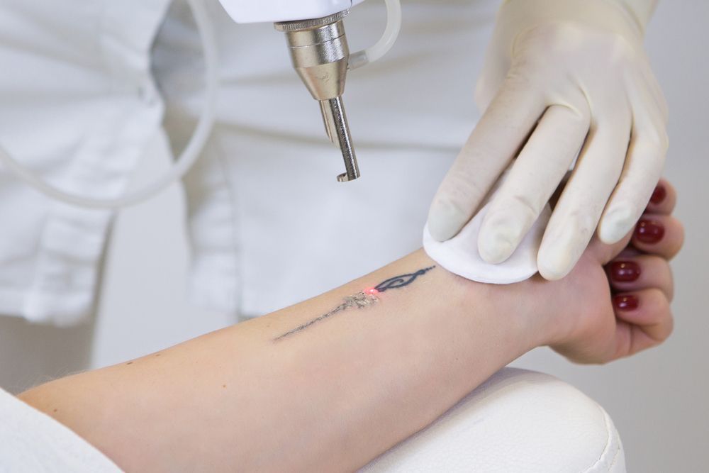 A Person is Getting a Tattoo Removed From Their Arm — Aqua Marine Skin and Beauty in Tuncurry, NSW