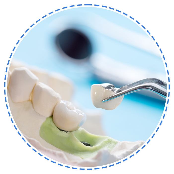 Close Up Implant and Prosthodontic Model — Launceston, TAS — Everything Dental Pty Ltd Close Up Implant and Prosthodontic Model — Launceston, TAS — Everything Dental Pty Ltd