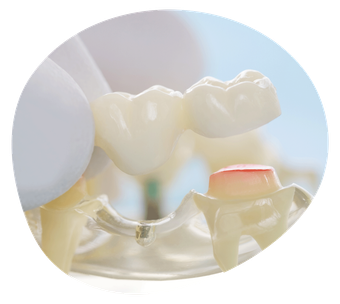 Crowns — Launceston, TAS — Everything Dental Pty Ltd Crowns — Launceston, TAS — Everything Dental Pty Ltd