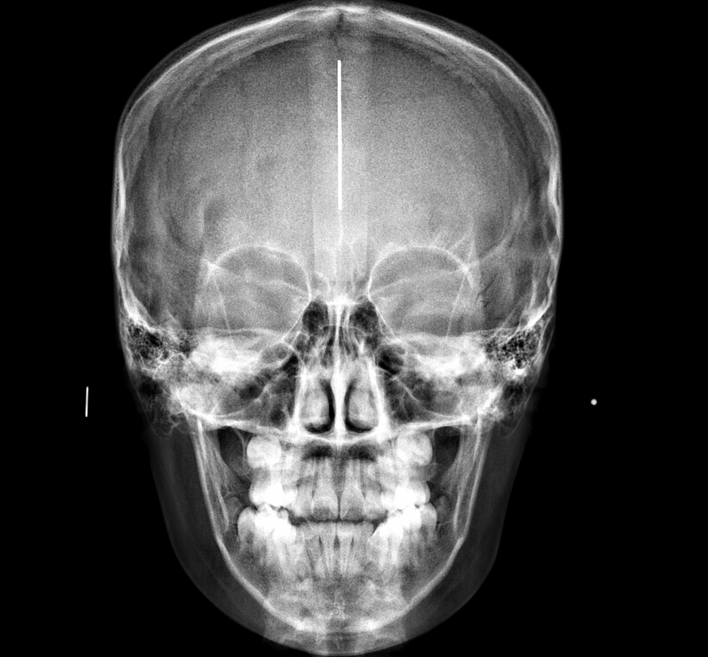 RX FRONTAL