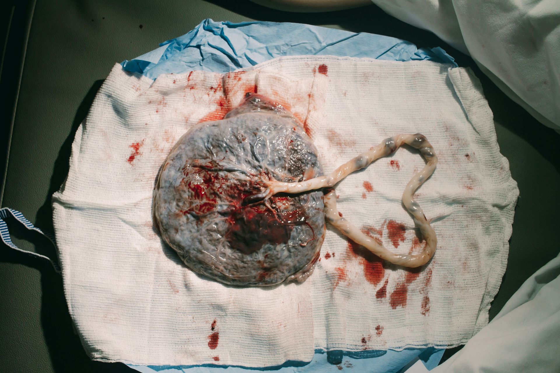 Learn about placenta encapsulation benefits, the process and safety precautions