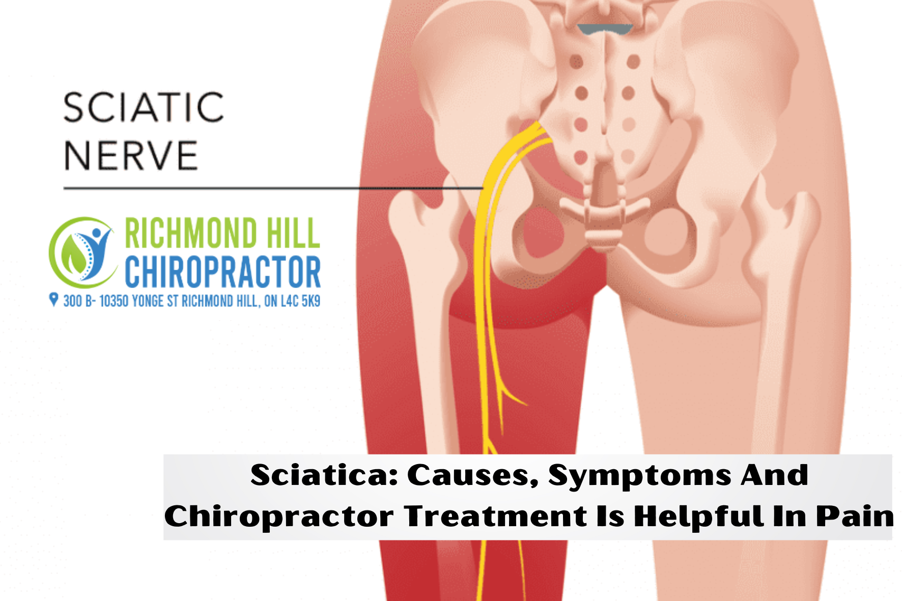 Sciatica: Causes, Symptoms
