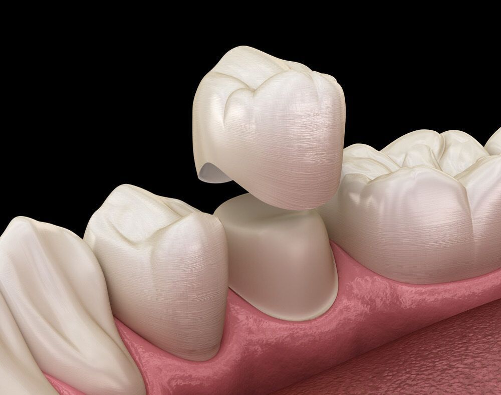 Close Up Of A Dental Implant In A Tooth — Byron Bay Dental in Byron Bay, NSW