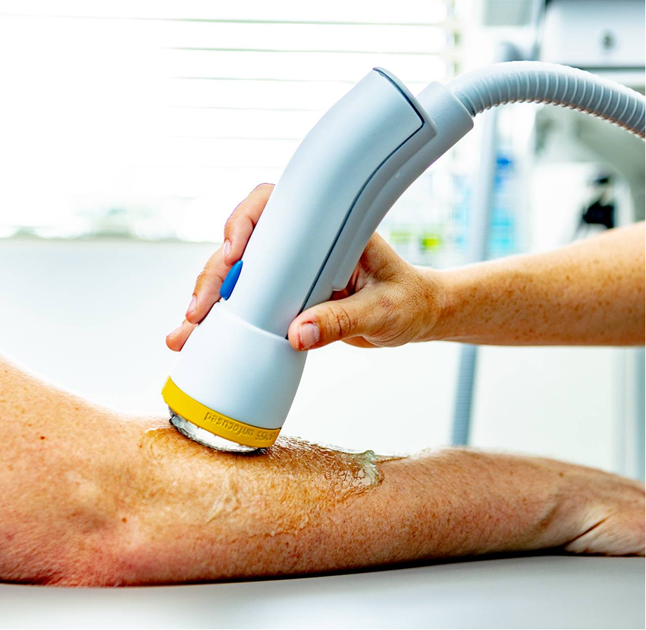 Handheld laser device treating a patient’s leg wound in a clinical setting