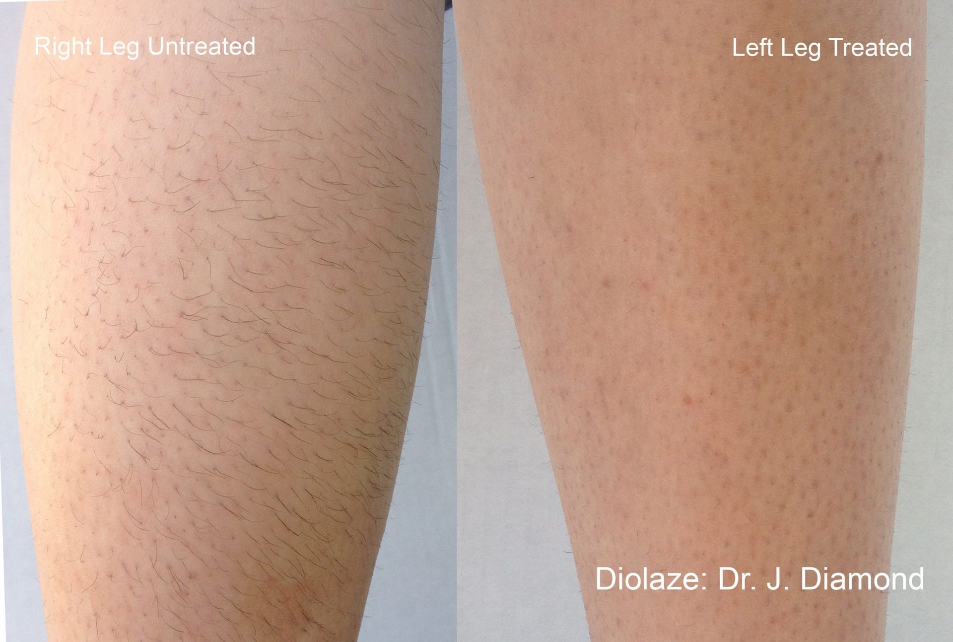 A before and after photo of a woman 's leg