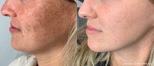 A before and after photo of a woman 's face.