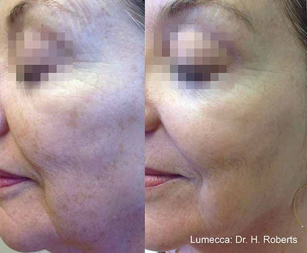 A before and after photo of a woman 's face.