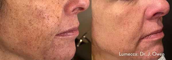 A woman 's face is shown before and after a treatment.