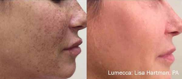 A before and after photo of a woman 's face with freckles.