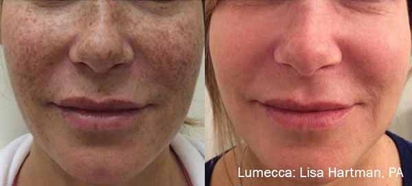 A before and after photo of a woman 's face.