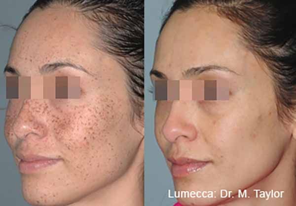 A before and after photo of a woman 's face.