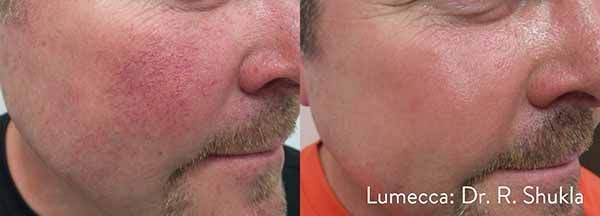 A man with a beard has red spots on his face.