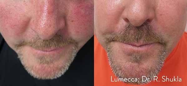 A before and after photo of a man 's face
