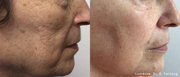 A before and after photo of a woman 's face.