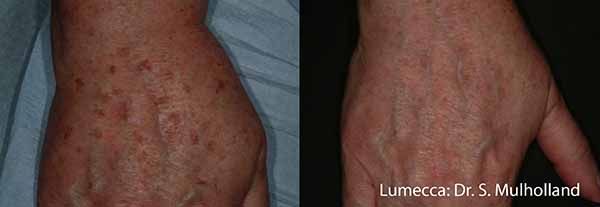 A before and after photo of a person 's hand