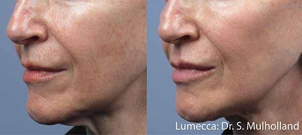 A before and after photo of a woman 's face.