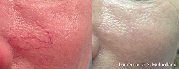 A before and after photo of a person 's face with red veins.