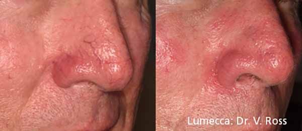 A before and after photo of a person 's nose.