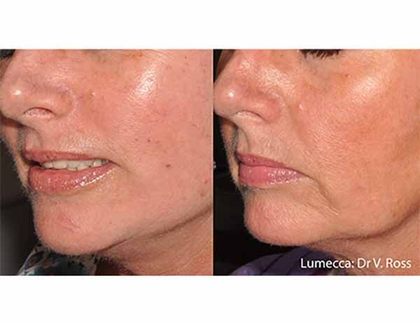A before and after photo of a woman 's face.