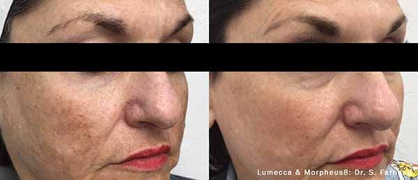 A before and after photo of a woman 's face.