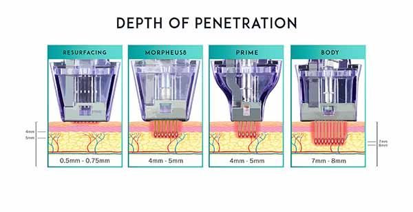 microneedling