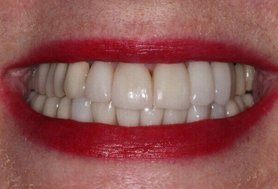 dental-implant-After