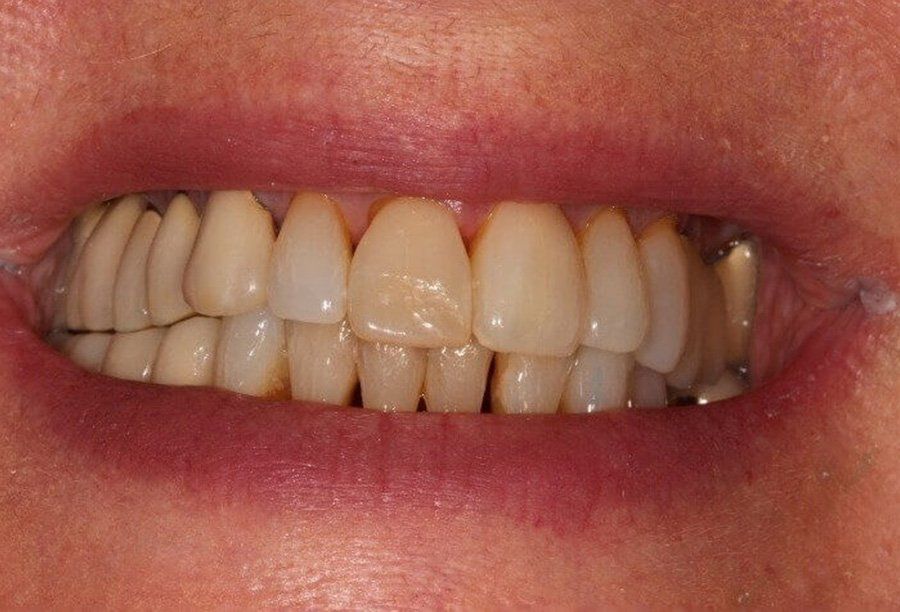 dental-implant-before-and-After