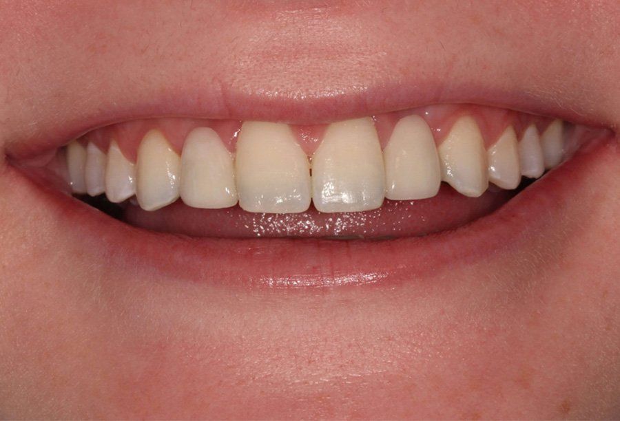restorative-dentistry-after