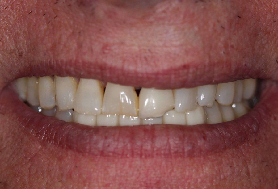 tribeca-smiles-ny-bone-grafting