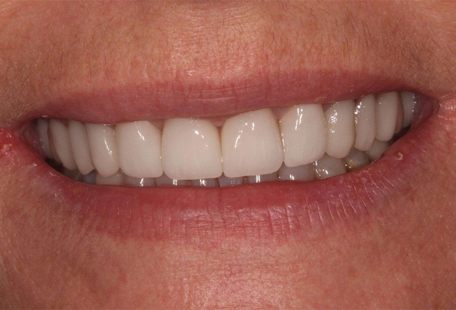 tribeca-smiles-ny-bone-grafting-after