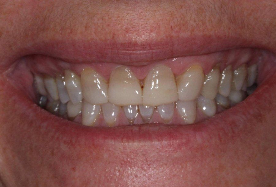 tribeca-smiles-ny-bone-grafting-before