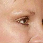 After Botox Anti-Wrinkle Injections