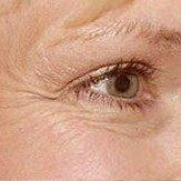 Before Botox Anti-Wrinkle Injections