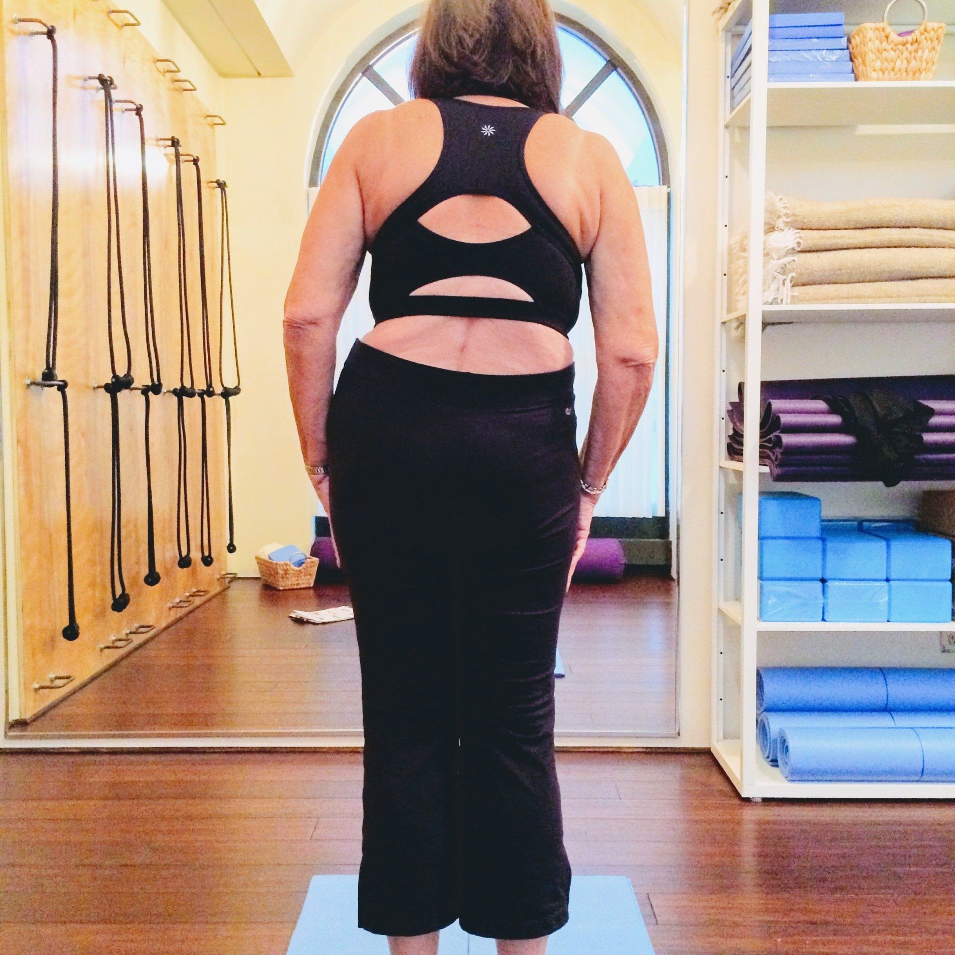 scoliosis hip shift