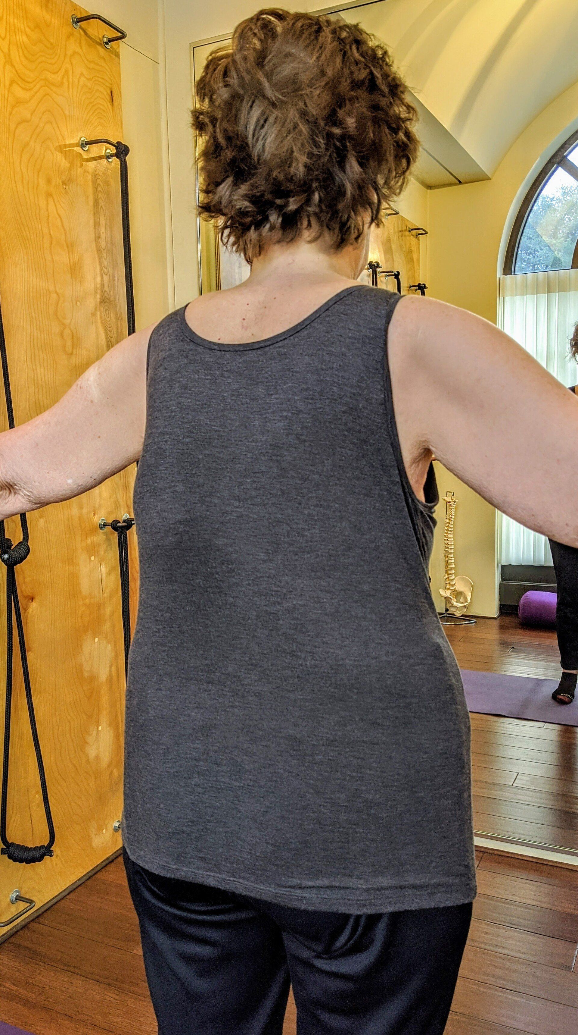 scoliosis